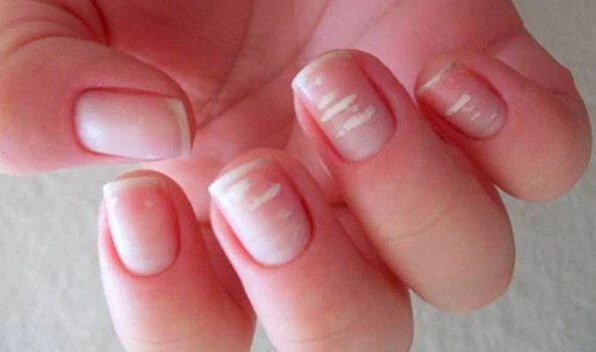 Белые пятна на ногтях